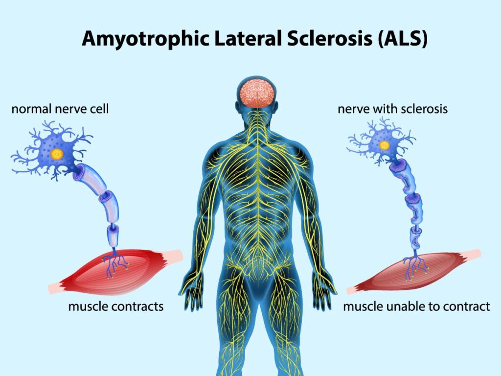 amyotrophic lateral sclerosis